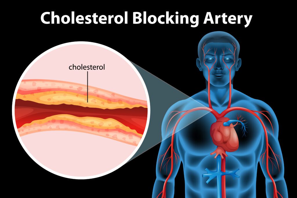 Cholesterol