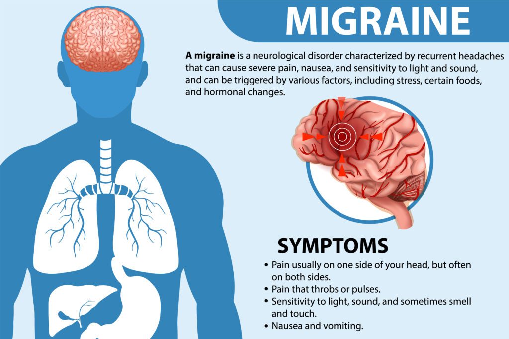 ICD-10 Codes for migraine